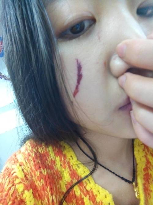 我的脸上前几天被人抓伤了,怎样才能不留下疤痕啊?拜托了各位.脸上被抓伤如何避免留疤?紧急求助 我的脸上前几天被人抓伤了,怎样才能不留下疤痕啊?拜托了各位.脸上被抓伤如何避免留疤?紧急求助